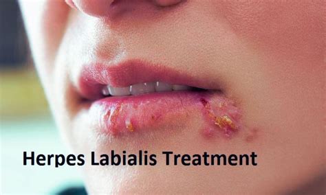 labial herpes better medical treatment